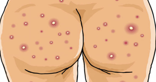 IF YOU HAVE THOSE ANNOYING ACNE ON YOUR BUTT, YOU NEED TO READ THIS